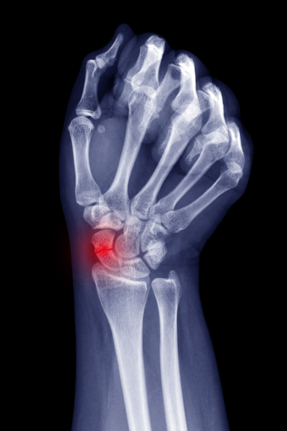 Fracture Du Scapho de Dr Maxime Rousi 